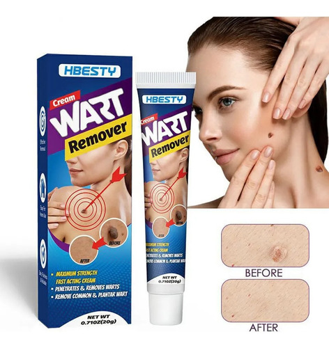 Removedor De Creme Para Remoção De Verrugas E Toupeiras.