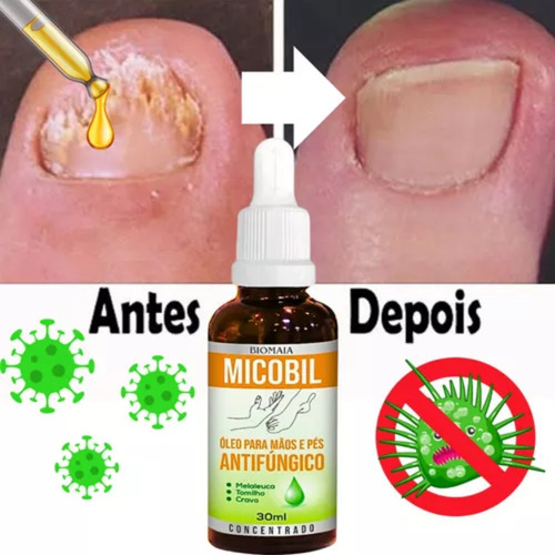Micose Entre Os Dedos Do Pé Antimicótica Micose Unha Fungos