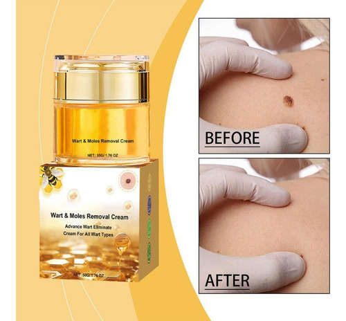 Crema De Eliminación De Lunares De Verruga Venenosa De Abeja