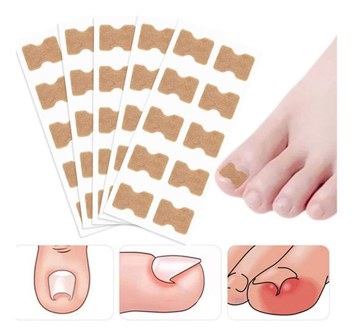 Parche Para Uñas Encarnadas,parche Corrector De Uñas De Los