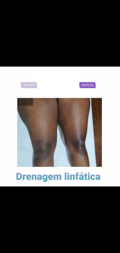 Imagem 3 de 4 de Drenagem Linfática Método Joana Medrado