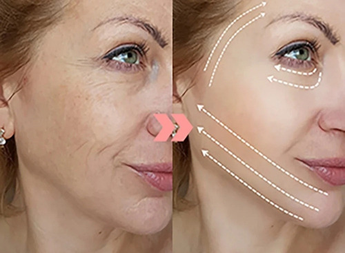 Prosculp Gua Sha Lifting + Matrixyl 3000+cream Gel+ 60 Hilos