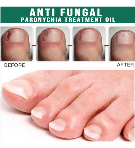 Solução De Reparo De Unhas Cinza Esmalte Para Unhas Para Pés