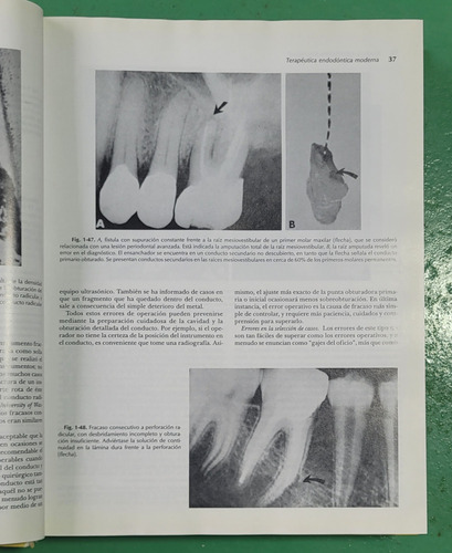 Endodoncia - Ingle - Bakland #e2 (Usado)