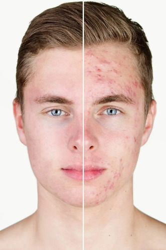 Lapiz Secativo P/ Acne E Imperfecciones Cover Sec Lidherma Momento De Aplicación Día/noche Tipo De Piel Grasas