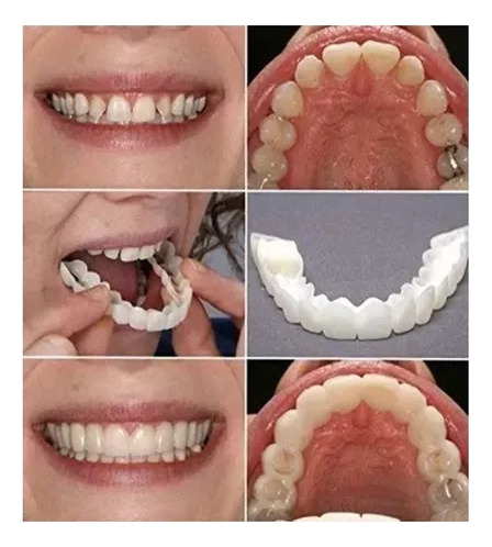 Facetas De Dentes Postiços De Sorriso Superior/inferior