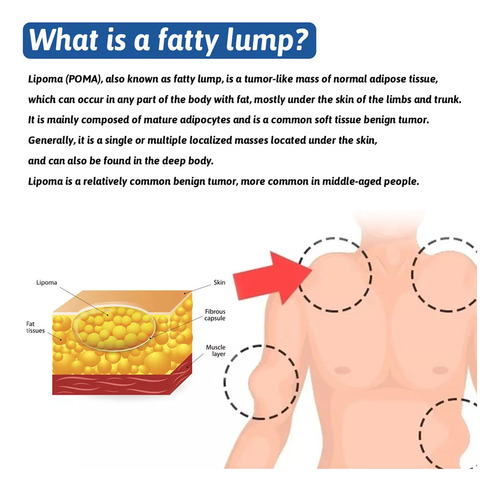 Productos Para El Cuidado De La Piel Lipoma Fatty Knot En Ae