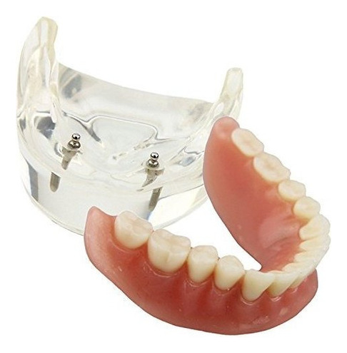 Dentales Modelo Sobredentadura Inferior 2 Implantes Demo Par