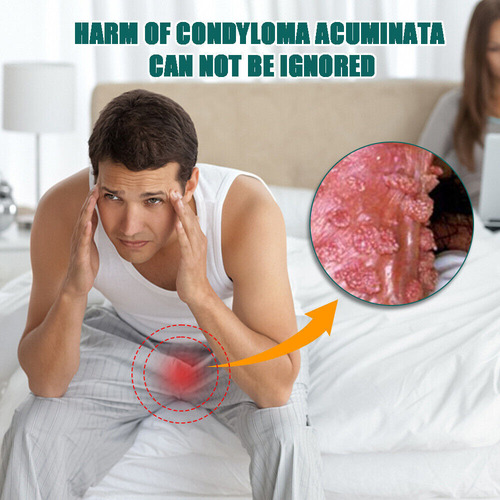 Xinnuo Pomada Para Eliminar Las Verrugas Del Herpes