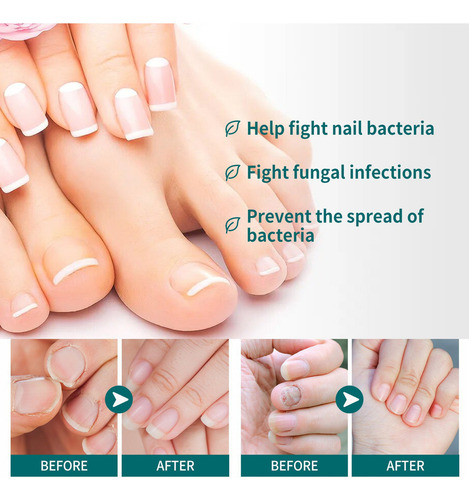 7×reparación La Decoloración Las Uñas Onicomicosis Soft
