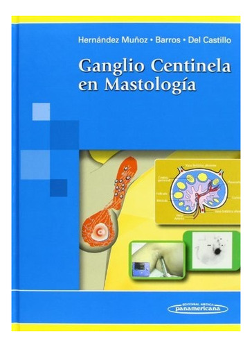 Ganglio Centinela En Mastología