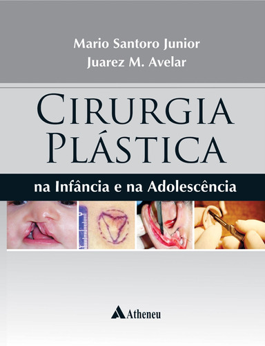Cirurgia plástica na infância e na adolescência, de Junior, Mario Santoro. Editora Atheneu Ltda, capa dura em português, 2018