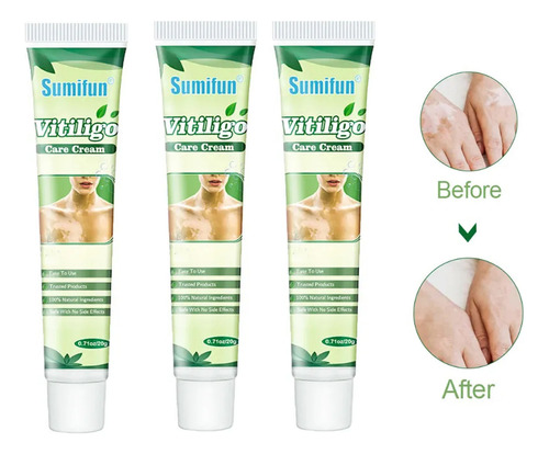 Crema Natural Para Tratar Vitiligo 3und