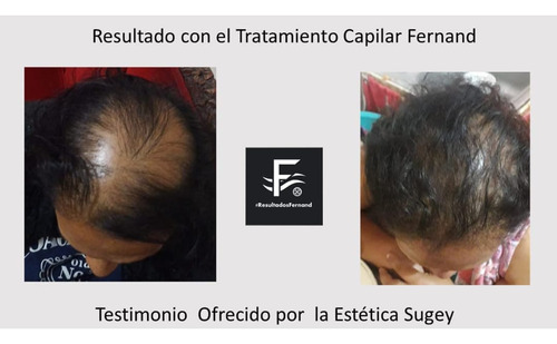 Solución Anticaida Para Hombre Con Cabello Con Caspa