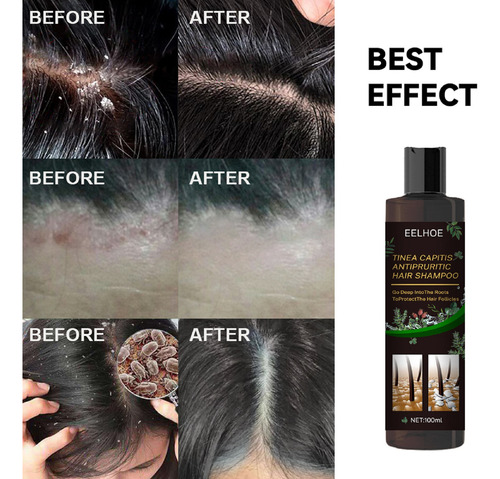 Anti-itch Shampoo For Tinea Capitis To Remove Dandruff And R