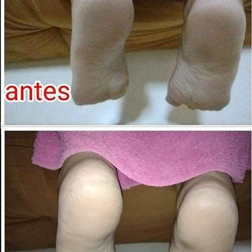 Imagem 5 de 5 de Plástica Dos Pés