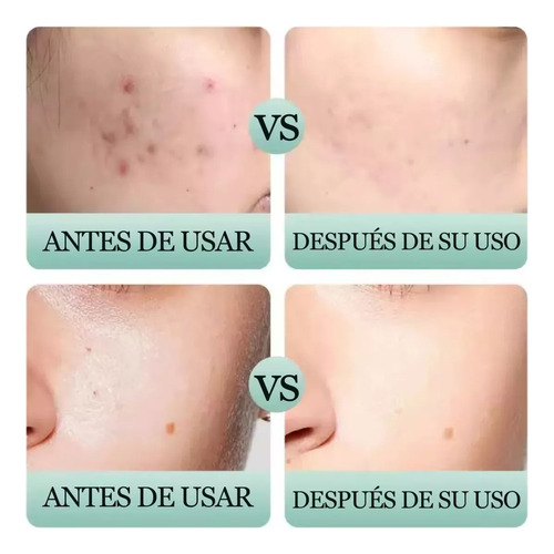 Jabón Espumoso Anti Acne Acido Salicílico + 12 Esponjas