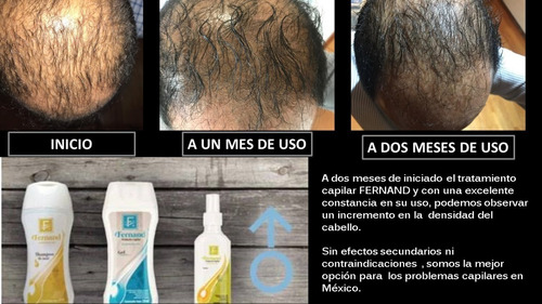 Solución Anticaida Para Hombre Con Cabello Normal
