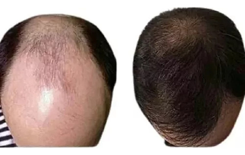 Tratamiento Para La Barba Cejas Original + Envio
