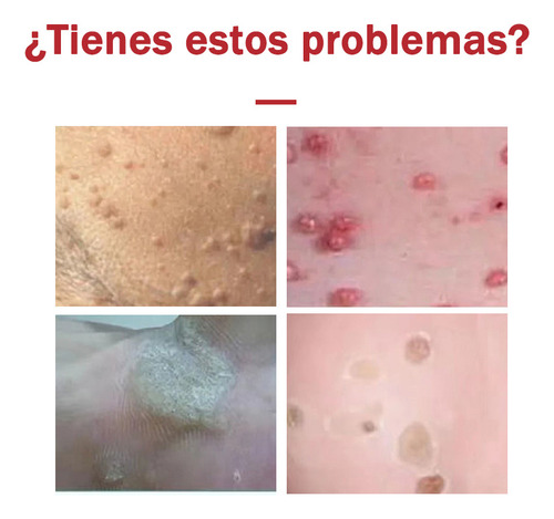 Crema Para Verruga Spointts Sigermel Antiverrugas Anti-vph