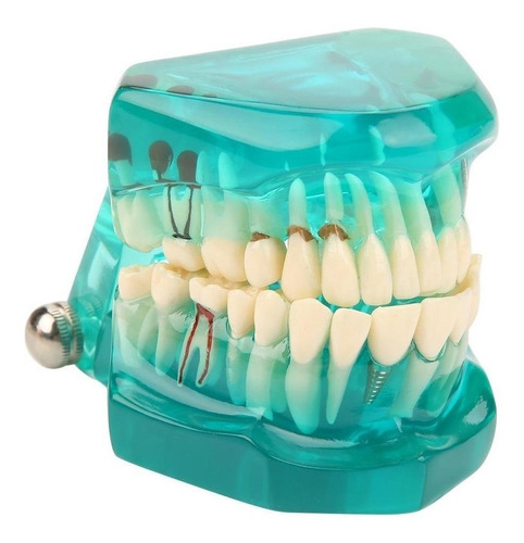 Modelo Educativo (verde), Enfermedad Dental, Modelo Dental