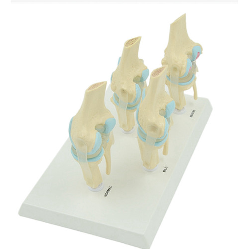 Modelo Anatómico De Articulación Degenerativa De La Rodilla