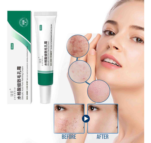 Creme Retrátil Creme Minimizador De Poros Com Ácido Salicíli