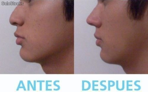 Respingador De Nariz - Cara Mas Delgada - Corrector Nasal