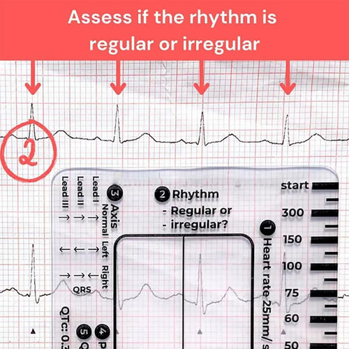 Regla De 7 Pasos Para Electrocardiogramas, Regla De Bolsillo