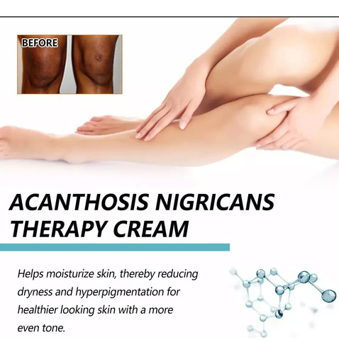 Mz Fixderma Nigrifix Crema Para Acantosis Nigricans Fbg