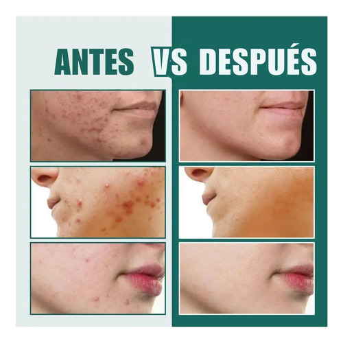 112 Star Parches Invisibles Eliminar Acné Granos Pegatinas