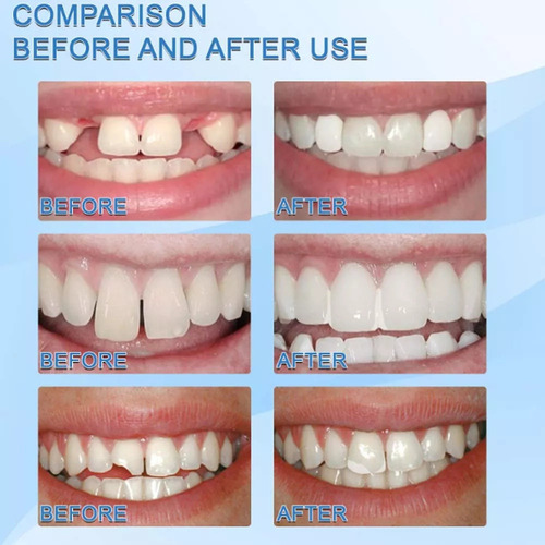 Kit De Perlas Para Reparación De Dientes, Paquete De 4