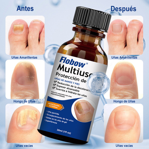 Para Eliminar Hongos En Uñas De Manos Y Piessolución, 30ml