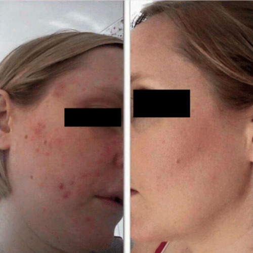Serum Reafirmante. Efecto Linfing. Dmae, Ácido Hialurónico Tipo de piel Todo tipo de piel