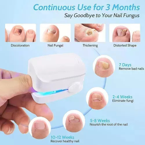 Mini Lámpara De Fototerapia Portátil Rápida Para Nas Fungi