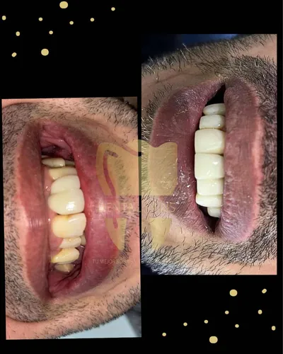 Carilla Dental En Resina (precio Por Unidad)
