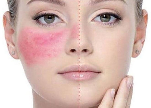 Imagen 2 de 6 de Crema Rosacea Piel Sensible Pack Natural + Jabón Y Tonico