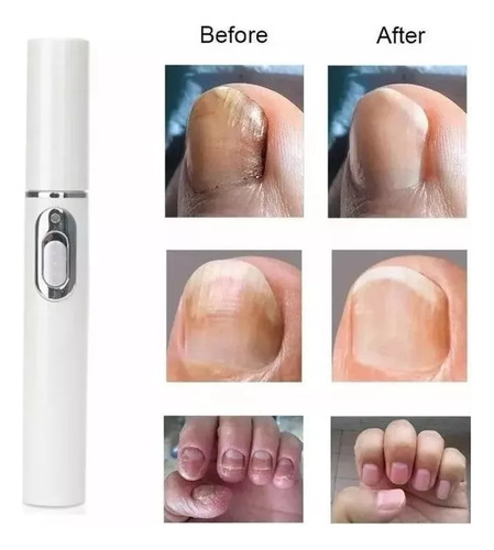 N Lápiz Láser Ligero Para Hongos En Las Uñas, 2 Unidades,