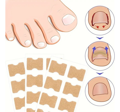 Adesivo Correção Unhas Encravadas Desencravador - 50 Peças