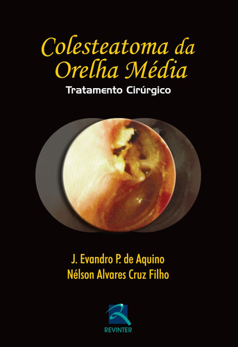 Colesteatoma da Orelha Média: Tratatamento Cirúrgico, de Aquino, J. Evandro P. de Aquino. Editora Thieme Revinter Publicações Ltda, capa mole em português, 2013