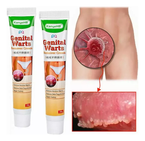 Un Ungüento Antiverrugas For Eliminar Verrugas Y Verrugas