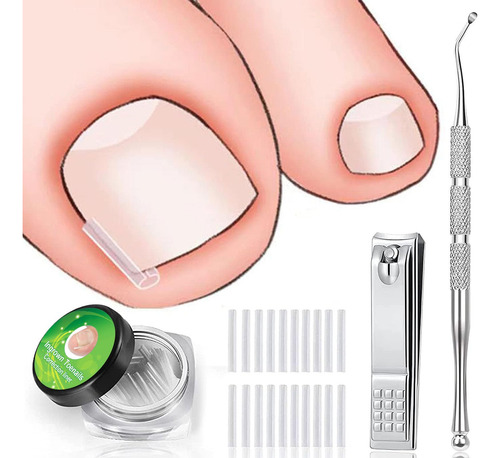 Kit De Eliminación De Uñas Encarnadas, 50 Pcs Corrector Con