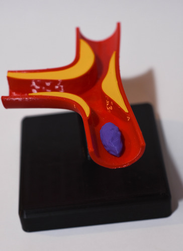 Maqueta Arteria Con Ateroma Semi Oclusivo - Medicina 3d