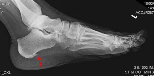 Imagem 5 de 6 de Palmilha Ortopédica De Silicone Para Esporão Facite Impacto