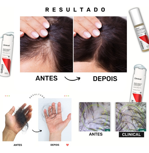 Shampoo Combate A Queda E Auxílio No Crescimento Clinical 25