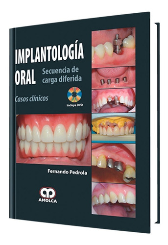 Implantología Oral. Secuencia De Carga Diferida.casos Clínic