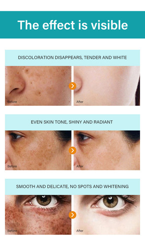 Q Dark Remover Cream Blanqueador De Pecas Y Peckle Rem