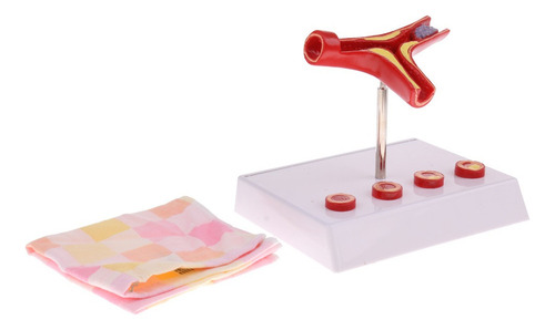 Modelo De Vascular De Trombo De Aterosclerosis De Vaso