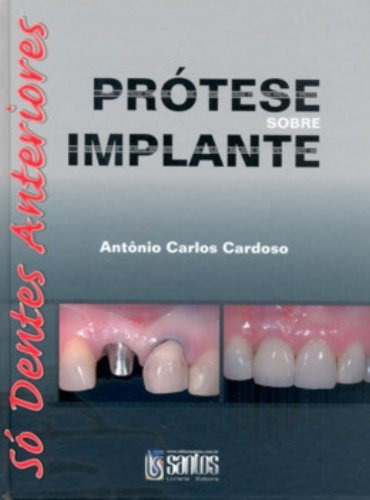 Prótese Sobre Implante - Só Dentes Anteriores, de Cardoso. Editorial Livraria Santos Editora Comércio e Importação Ltda., capa dura em português, 2008