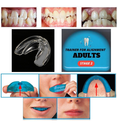 Ortodoncia Invisible En Cuotas Adultos Bracket Agnovedades